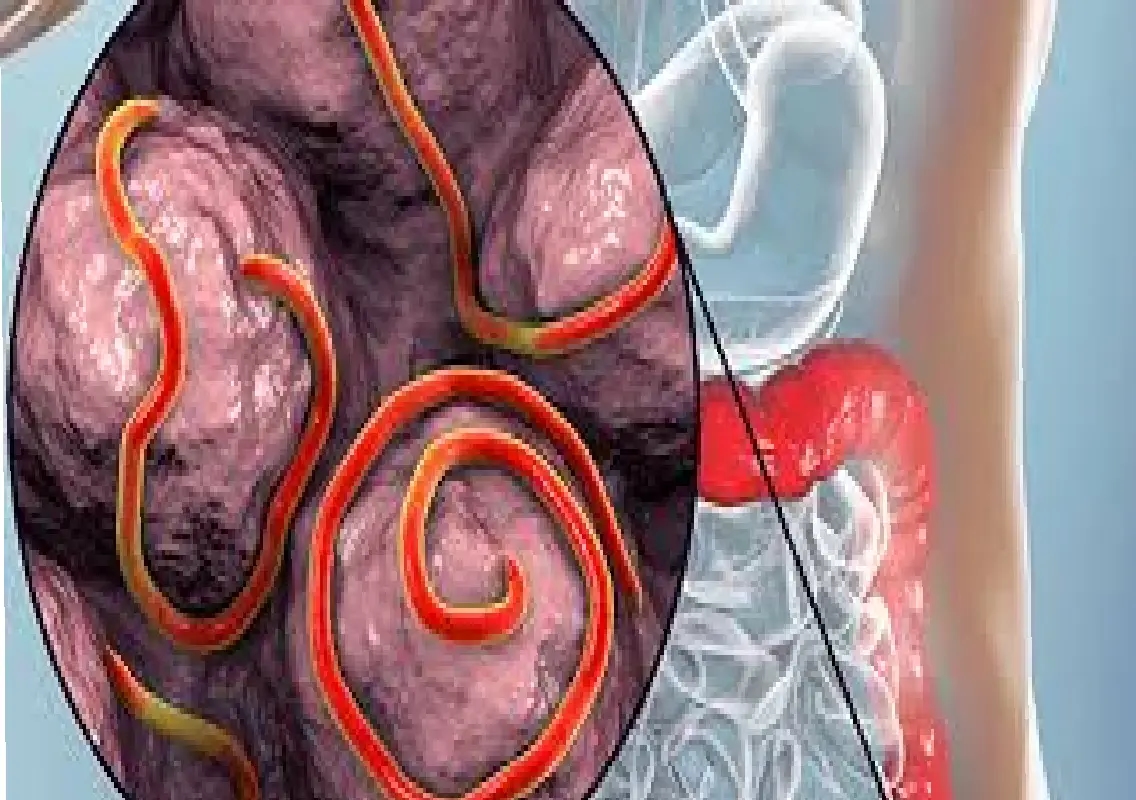 Teen’s stomach pain turns fatal due to rare parasite - News Karnataka
