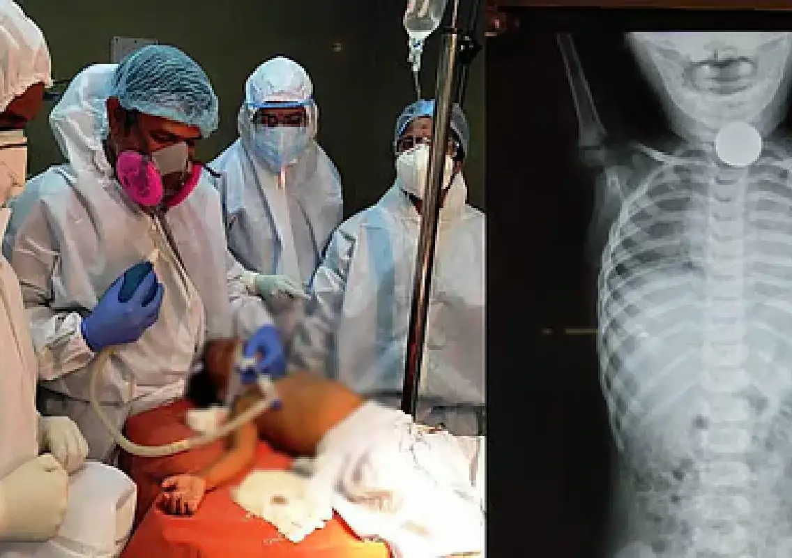Doctors save 4-year-old after coin gets stuck in throat - News Karnataka