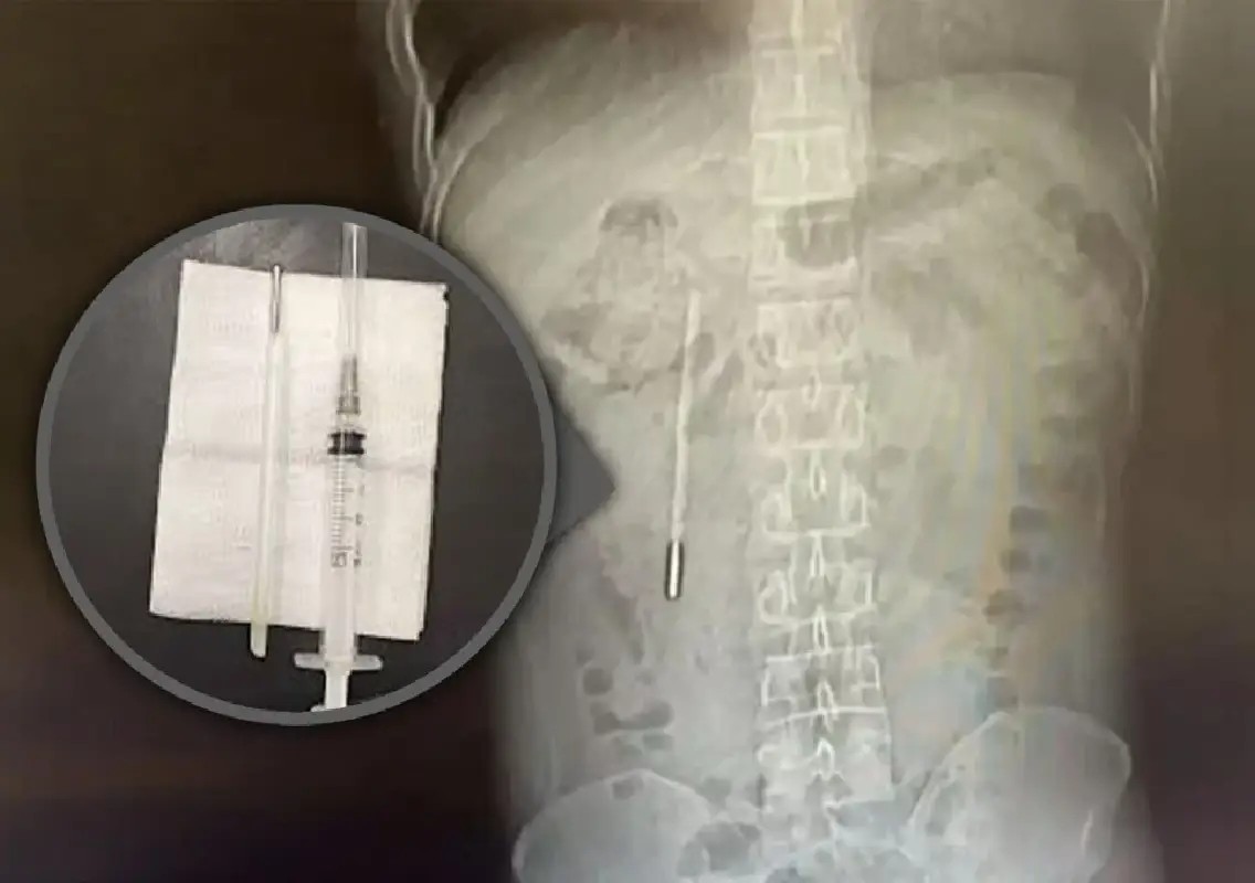 Man lives 20 years with thermometer inside body - News Karnataka