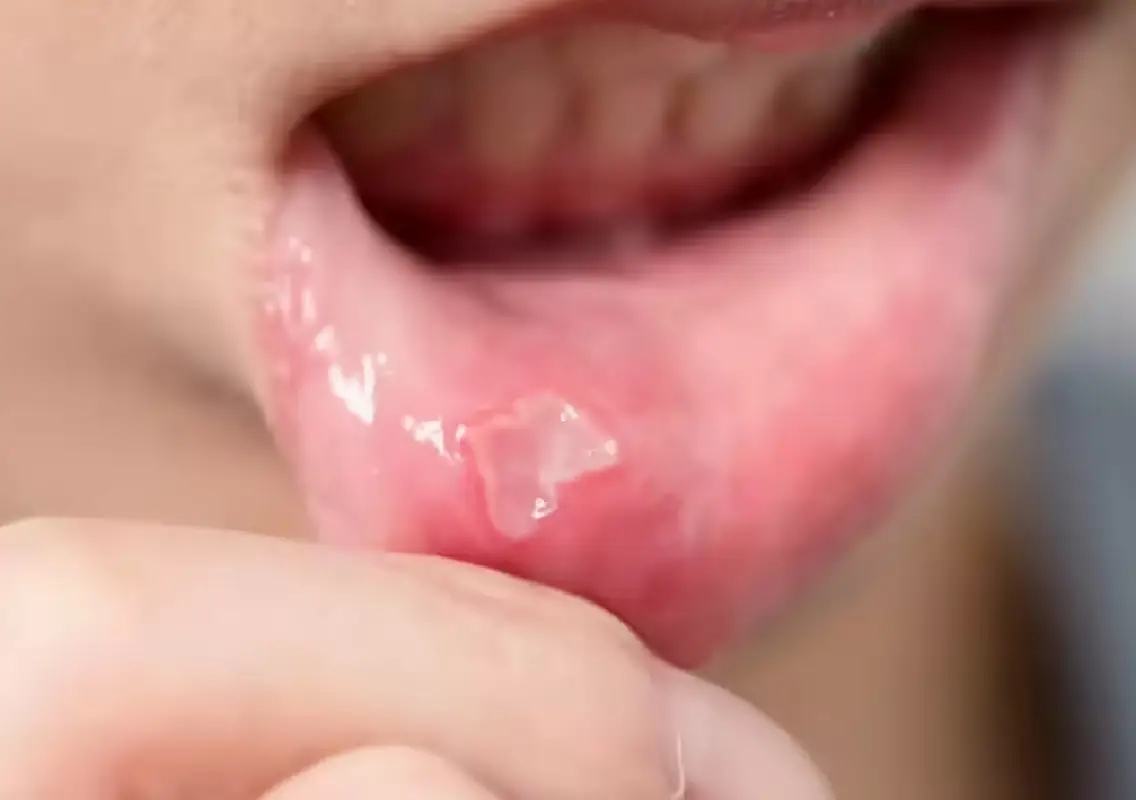 Oral cancer now rising among Bengaluru youth, doctors warn - News Karnataka