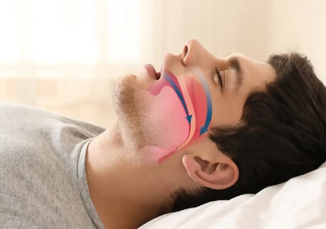 Man breathes better after sleep apnea surgery in Bengaluru - News Karnataka