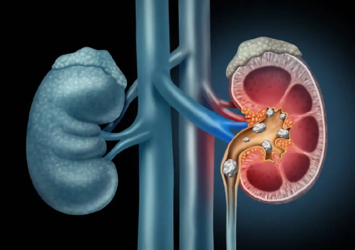 Water alone may not prevent kidney stones, study finds - News Karnataka