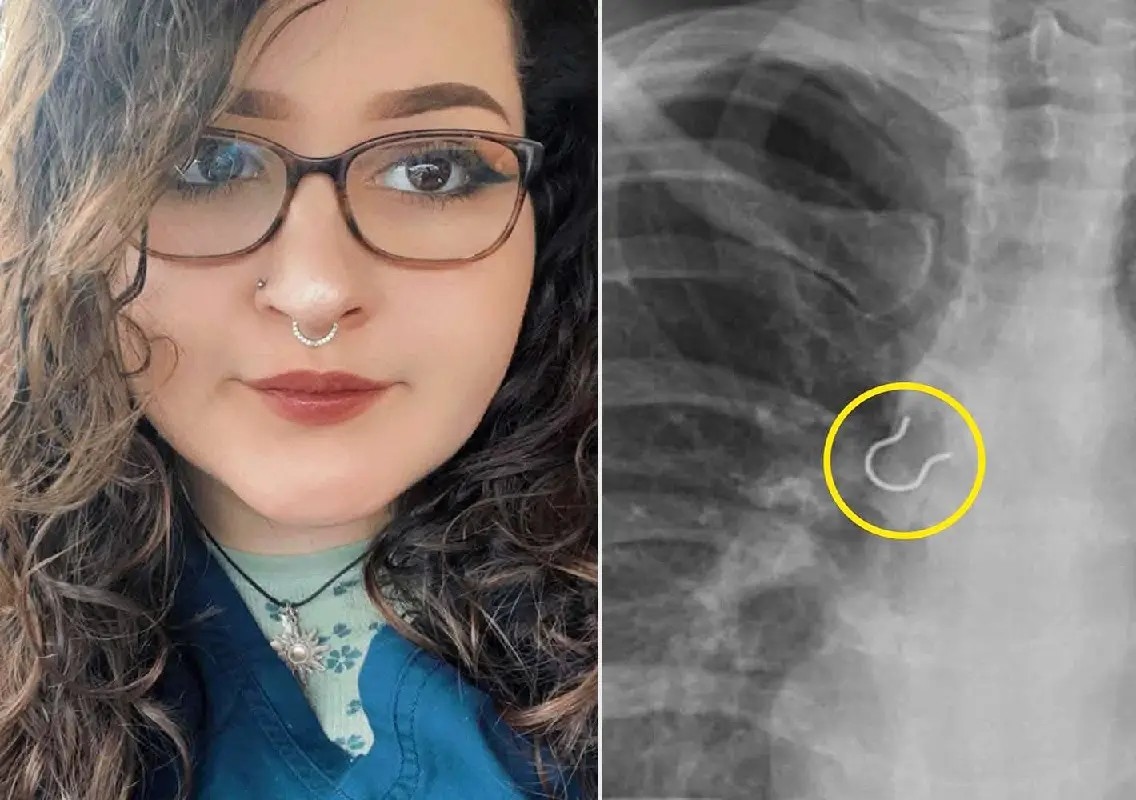 Woman discovers missing nose piercing lodged inside lung airway - News Karnataka