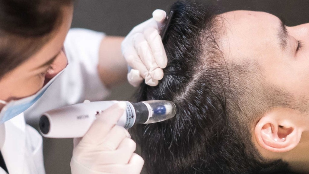 Hair Treatment in Bangalore: Does Hair Grafting Fit? - News Karnataka