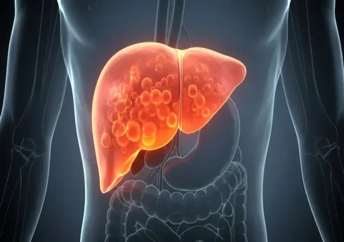 Fatty liver cases rising among children, experts stress early prevention - News Karnataka