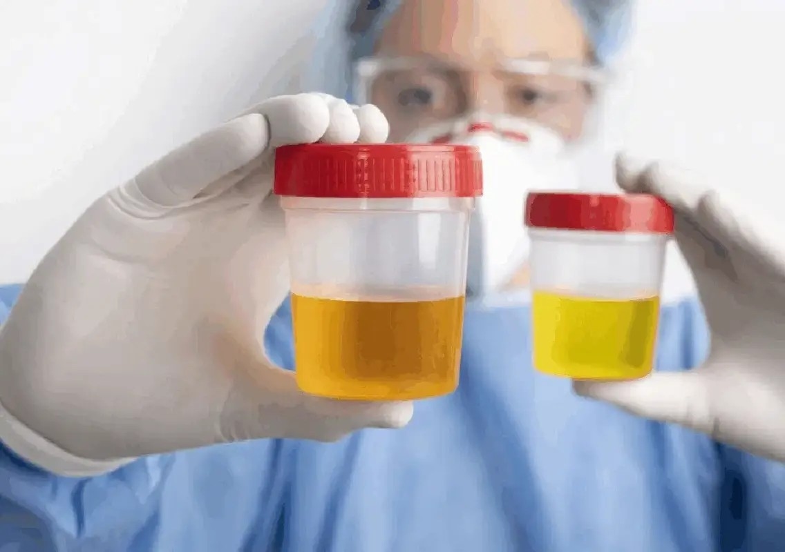 Urine colour alone cannot reveal kidney health, experts warn - News Karnataka