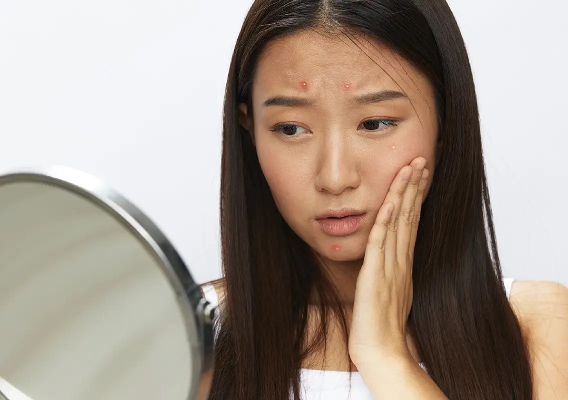 Can stress trigger acne? Experts explain the skin-mind link - News Karnataka