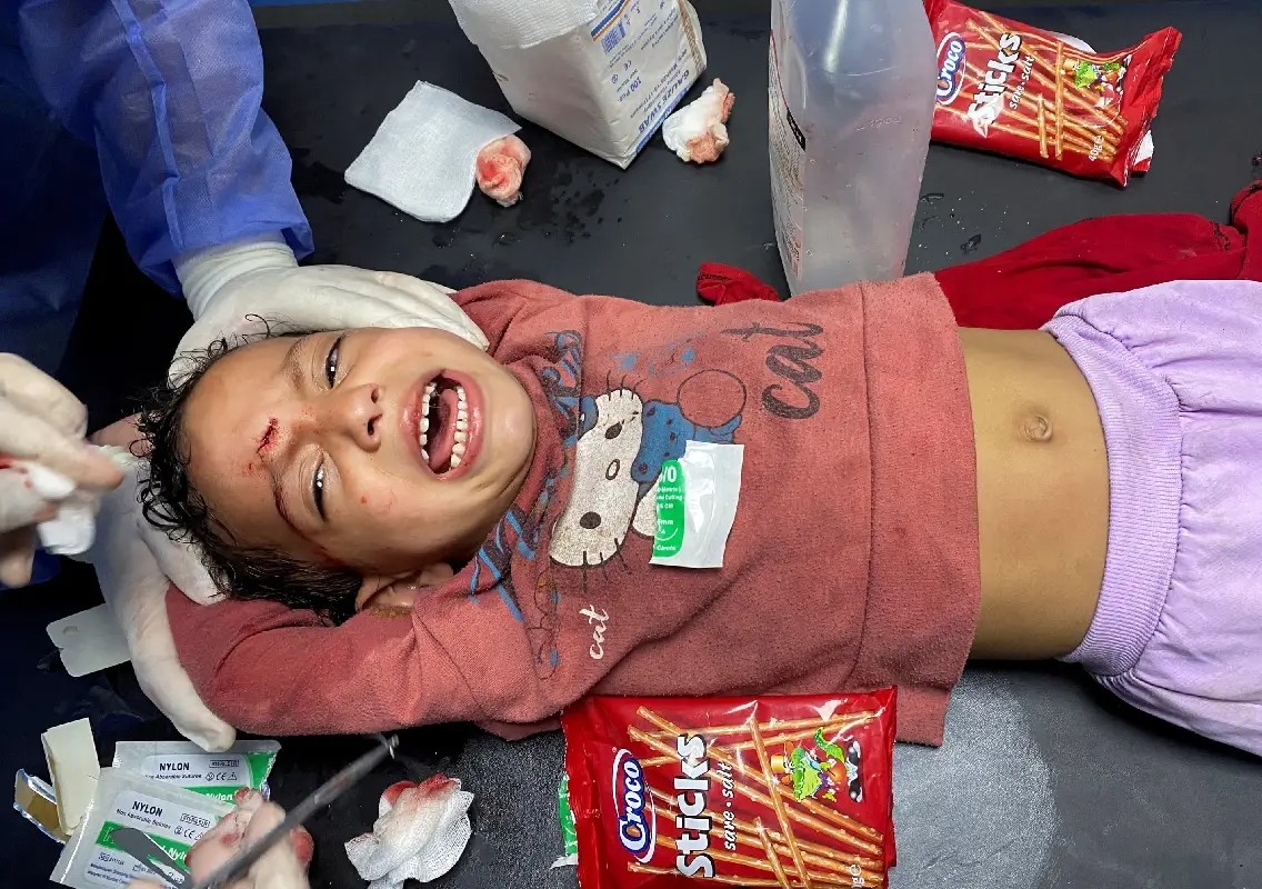 Five-year-old girl undergoes amputation in Gaza without anaesthesia - News Karnataka