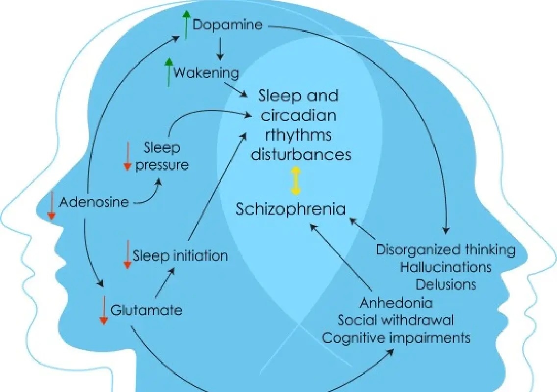 Irregular sleep patterns may signal schizophrenia, finds study - News Karnataka