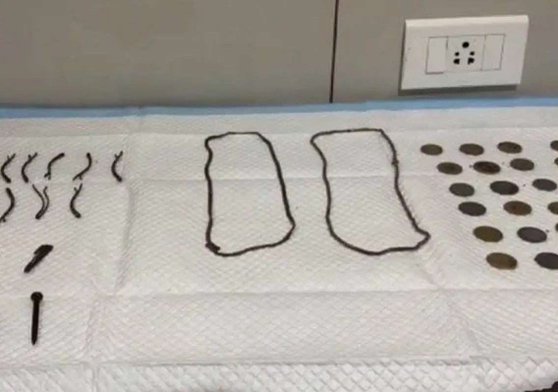 Tamil Nadu doctors remove 23 coins from 16-year-old’s stomach - News Karnataka