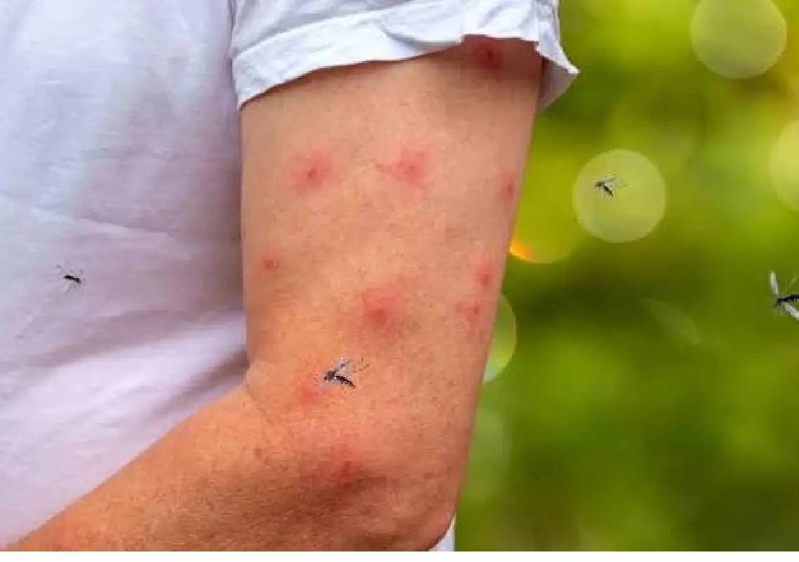 Why mosquito bites swell more on some people than others - News Karnataka