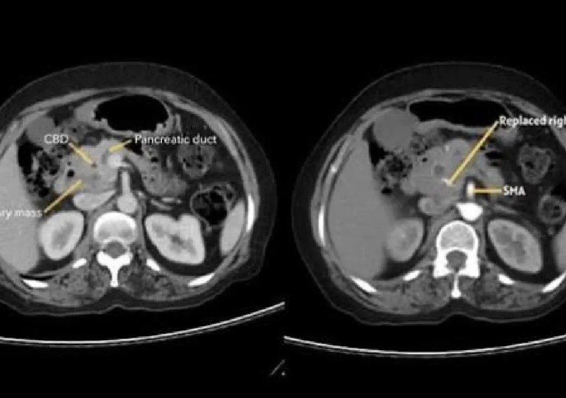 Manipal surgeons remove pancreatic cancer through keyhole robotic surgery - News Karnataka