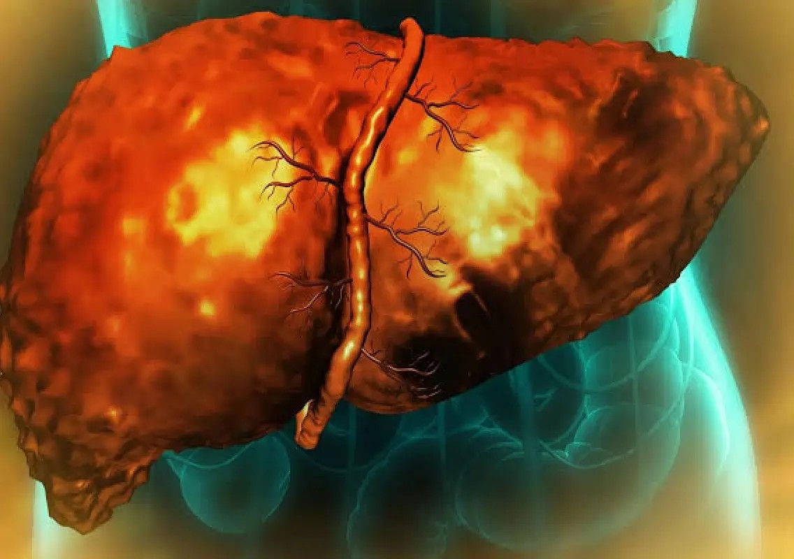 Why the liver may struggle to heal after drinking stops - News Karnataka