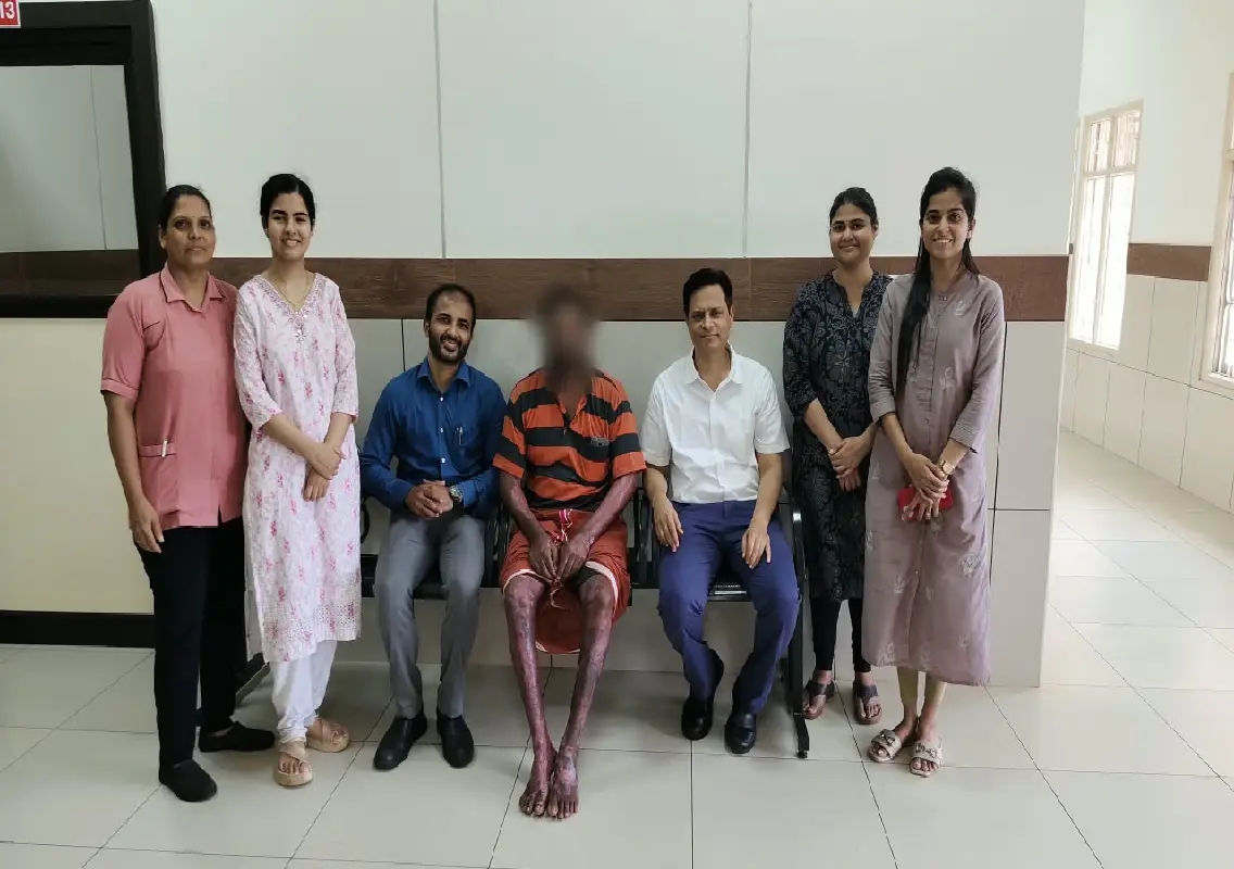 Father Muller hospital helps patient with 65% burns recover and return to work - News Karnataka