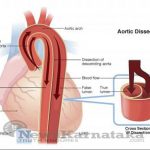 2cs Aortic Dissection