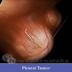 01 Thoracoscopic Tumour Excision Performed At Kmc Hospital Attavar