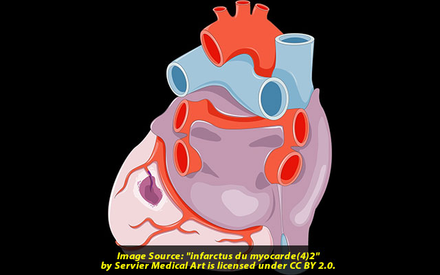 Myocarditis COVID19 is a much bigger risk to the heart than vaccination