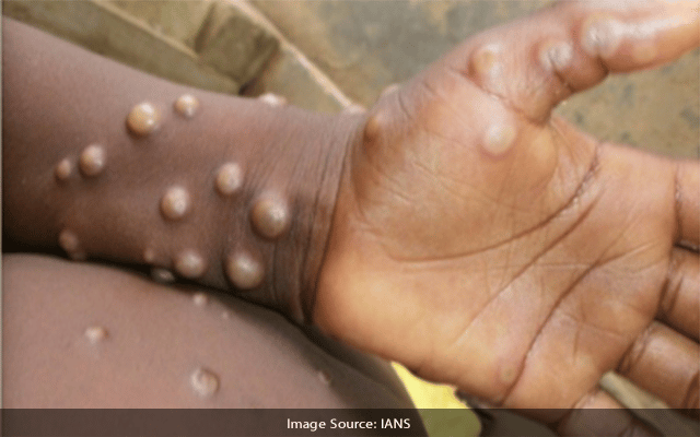 BiH confirms first monkeypox case