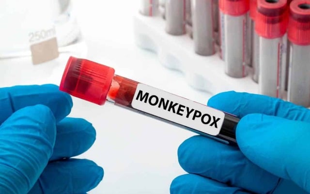 karnataka monkeypox