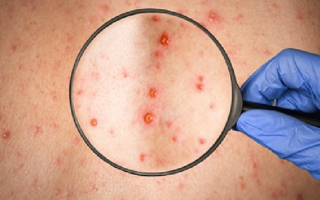 international team of researchers has found that varicella zoster virus
