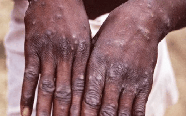 Russia registers first monkeypox case