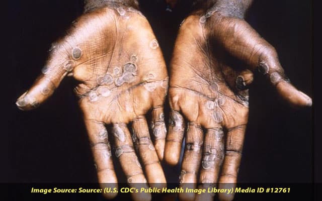 Why Monkeypox Isn’t An Sti And What Counts As Close contact