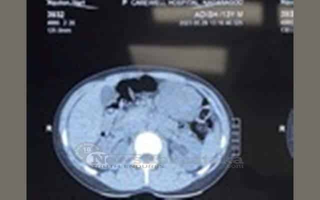 Rare abdominal tumour removed from 13-year-old in KMC Hospital