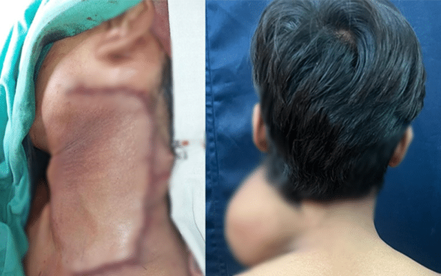 BMC hospital removes 2.5 kg tumour from teen's neck after 7 hr surgery