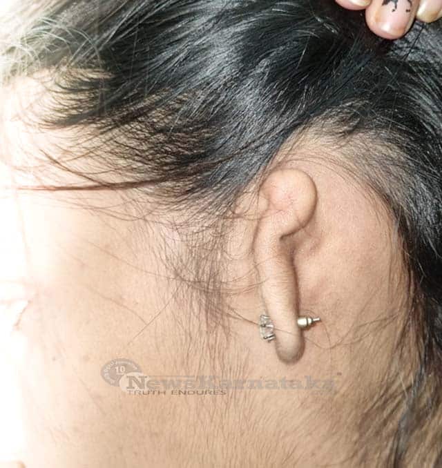 FMMCH conducts exemplary ear surgery for microtia on 24 year old