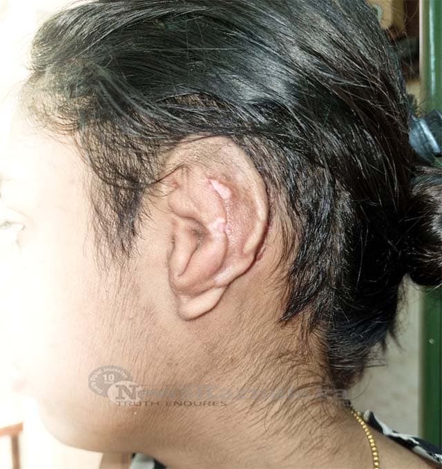 FMMCH conducts exemplary ear surgery for microtia on 24 year old TWO
