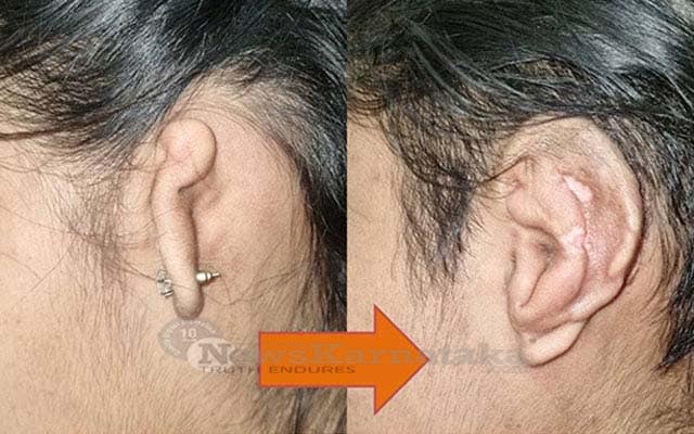 FMMCH conducts exemplary ear surgery for microtia on 24 year old