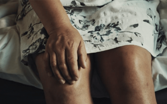 More than one in six arthritis patients are women, say doctors
