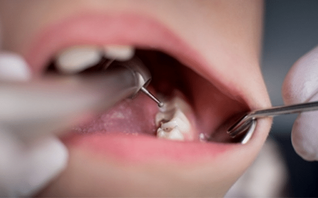 Study finds why tooth enamel damage occurs in celiac disease patients